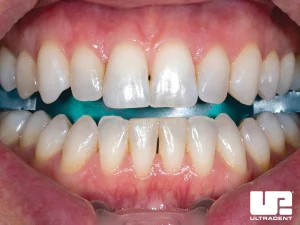 Place Ultradent IsoBlock™ bite block and self-supporting plastic cheek retractors. Completely rinse and air dry teeth and gingiva.